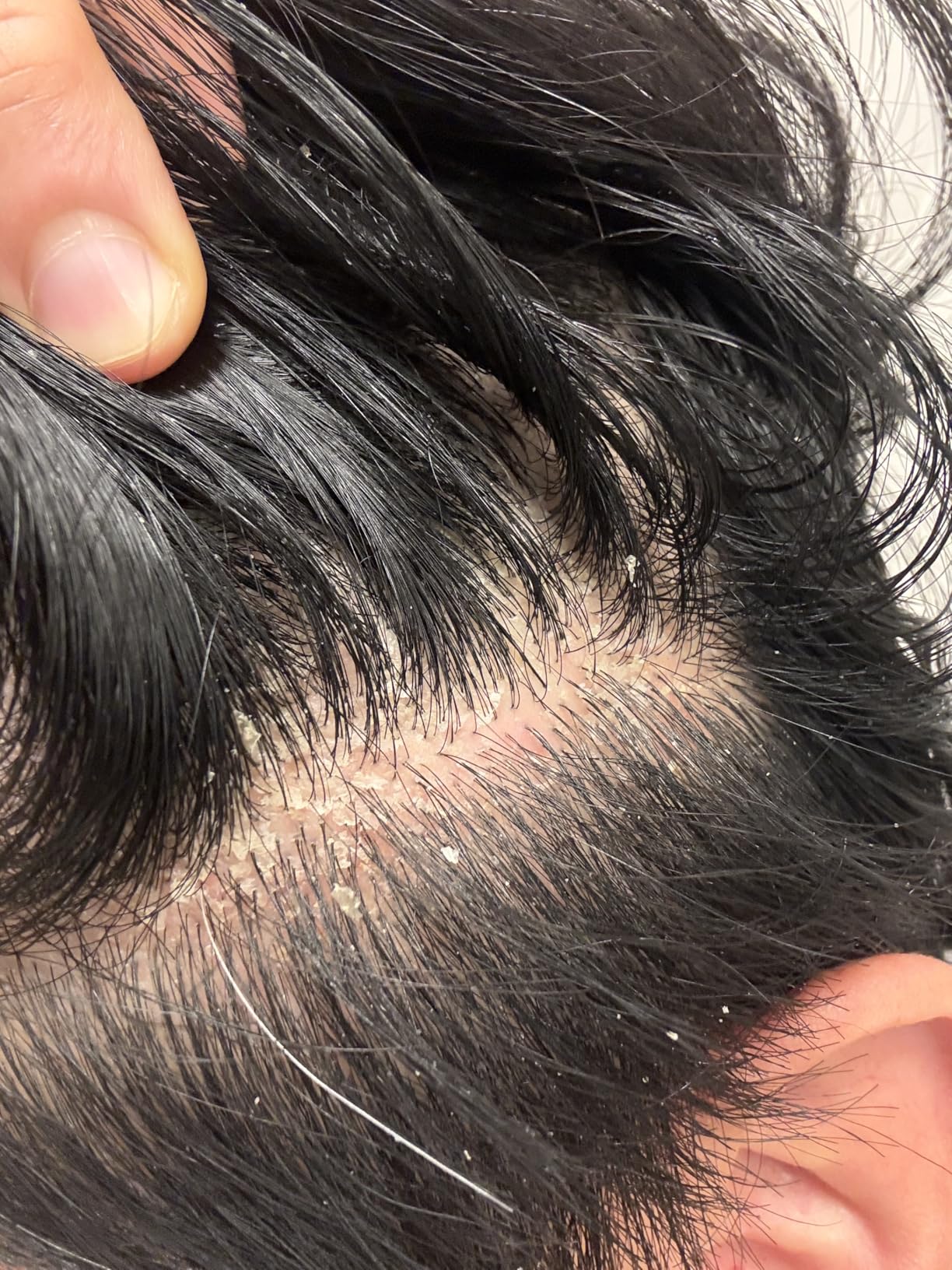 Selsun Blue Medicated Antidandruff Shampoo, Maximum Strength Scalp Treatment With Selenium Sulfide, 11 fl. oz. customer photo 1