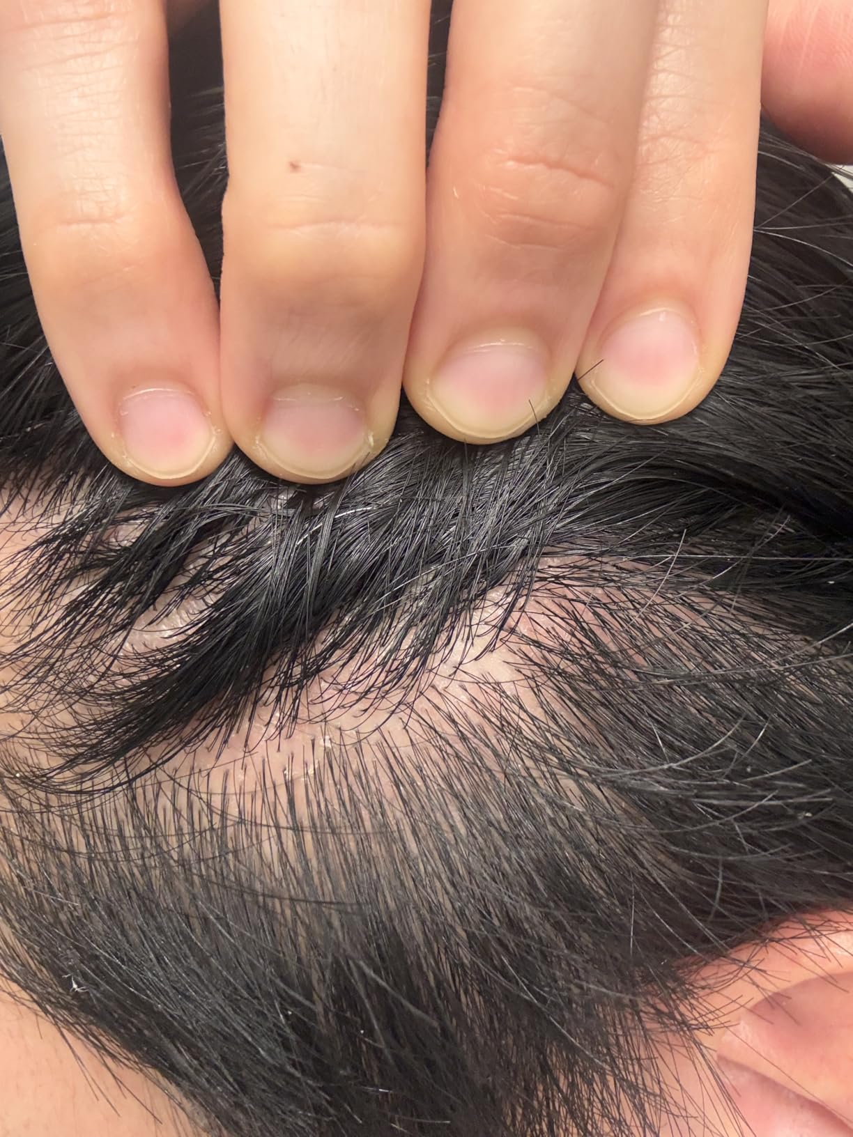 Selsun Blue Medicated Antidandruff Shampoo, Maximum Strength Scalp Treatment With Selenium Sulfide, 11 fl. oz. customer photo 2