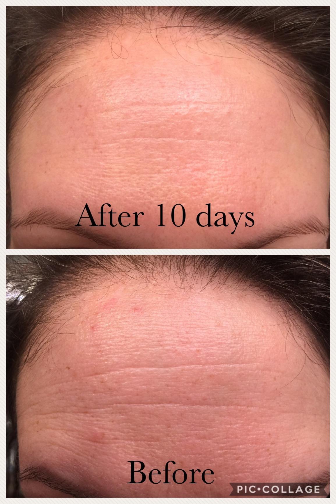 Neutrogena Rapid Wrinkle Repair Face Moisturizer SPF 30, 1 fl. oz | Retinol & Hyaluronic Acid, Anti-Aging Daily Face Cream, Smooths Fine Lines Wrinkles & Dark Spots customer photo 1
