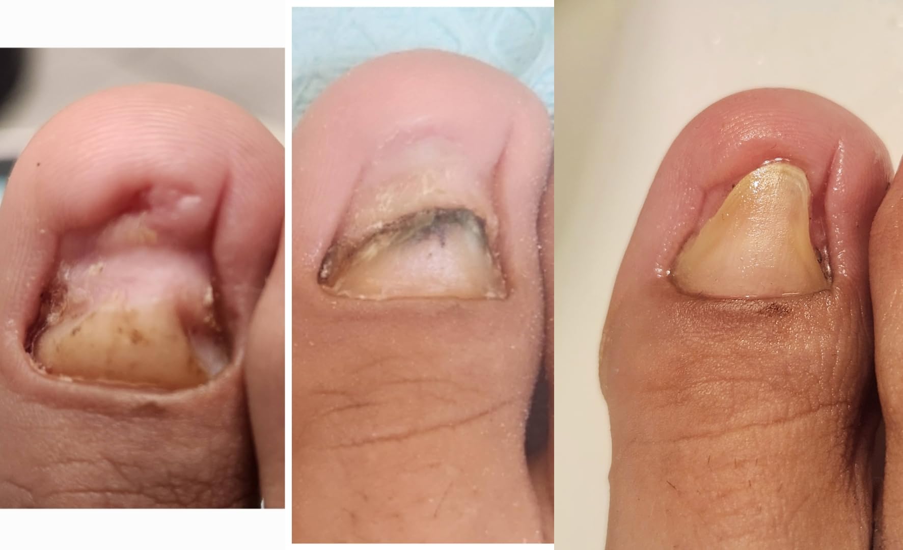 Kerasal Nail Renewal, Restorative Nail Repair for Damaged Nails customer photo 1