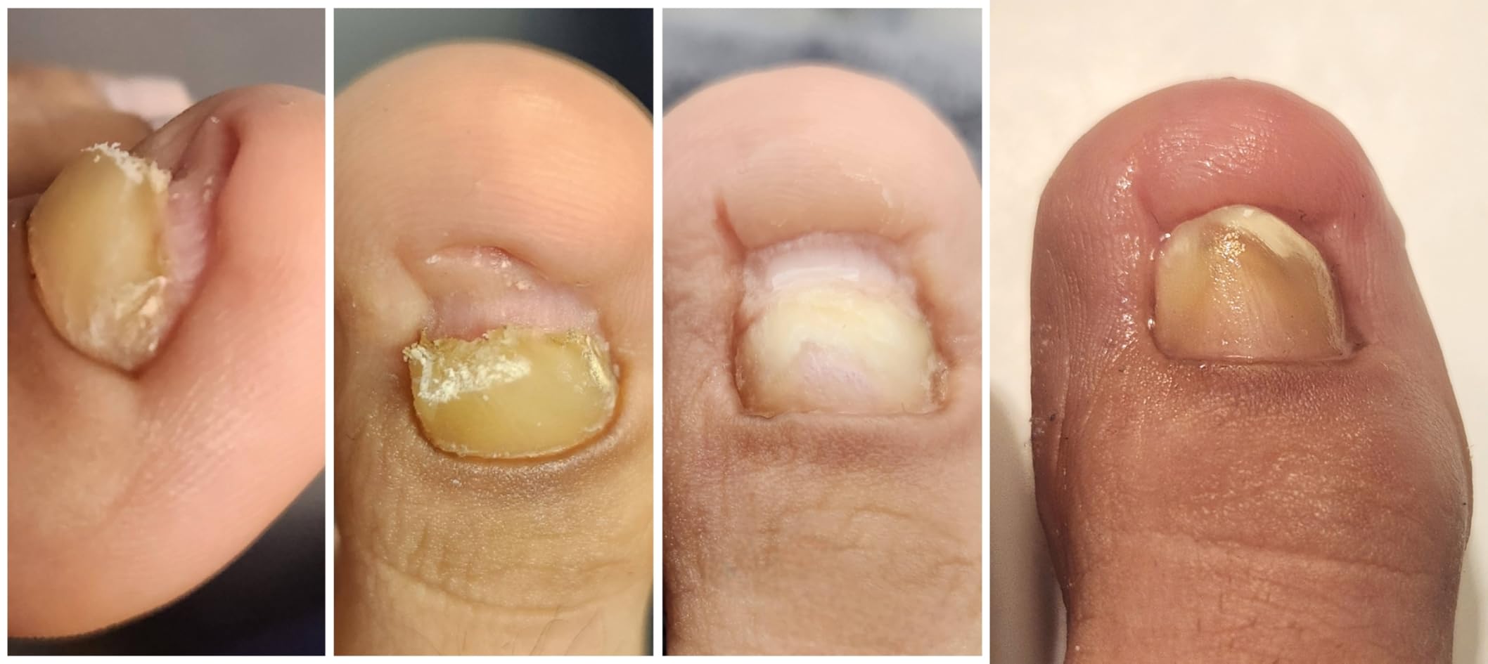 Kerasal Nail Renewal, Restorative Nail Repair for Damaged Nails customer photo 2