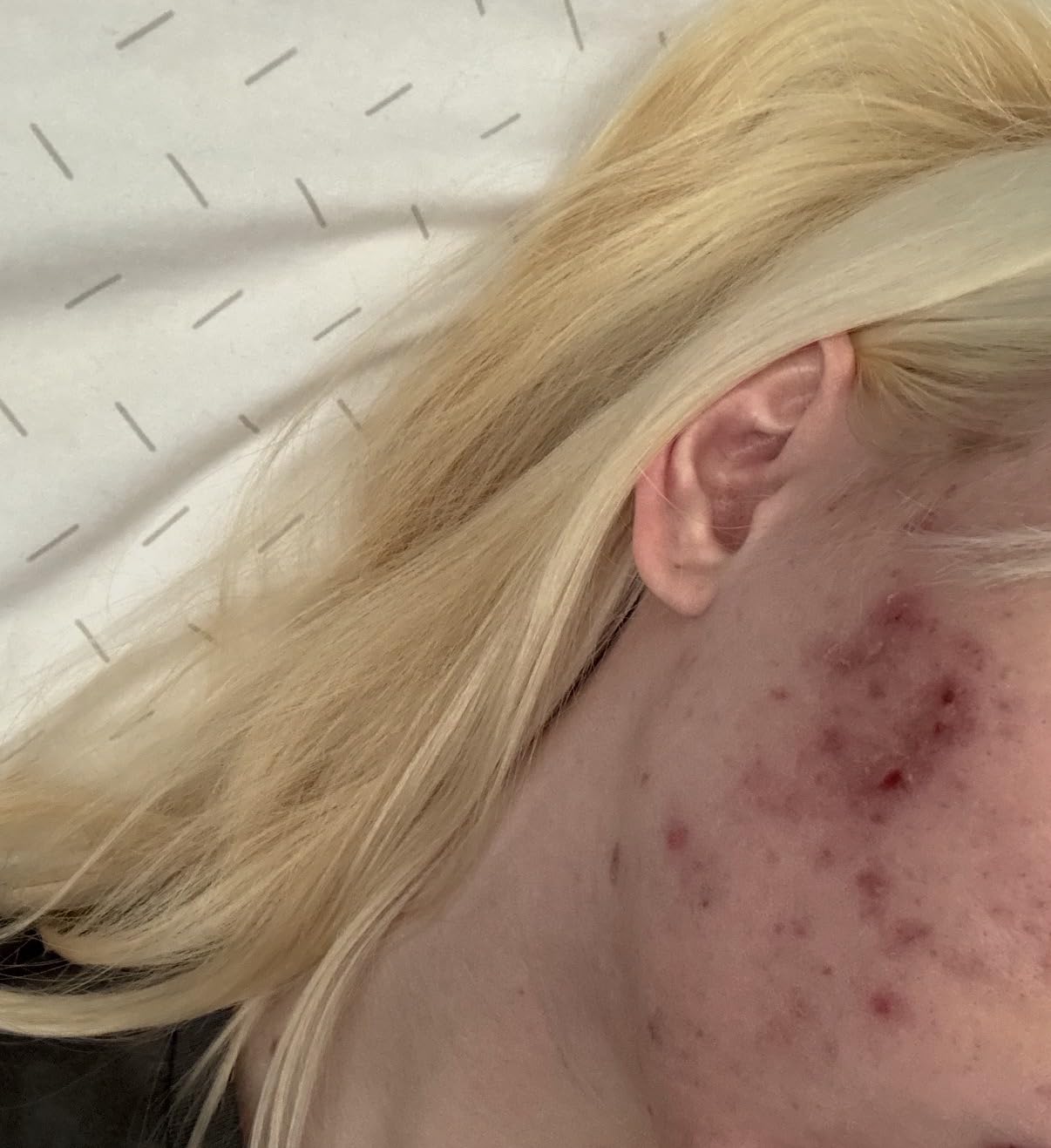 Acne Free 3 Step 24 Hour Acne Treatment Kit - Clearing System W Oil Free Acne Cleanser, Witch Hazel Toner, & Oil Free Acne Lotion - Acne Solution W/ Benzoyl Peroxide for Teens and Adults - Original customer photo 1