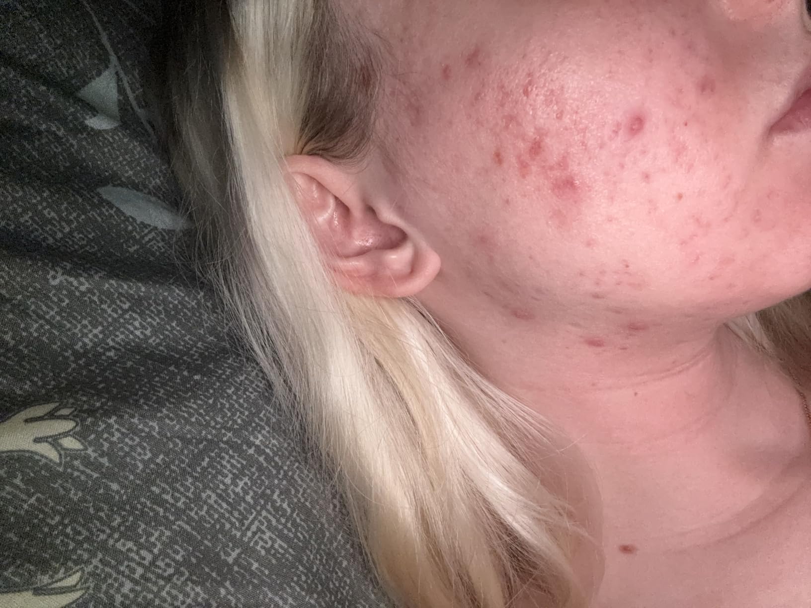 Acne Free 3 Step 24 Hour Acne Treatment Kit - Clearing System W Oil Free Acne Cleanser, Witch Hazel Toner, & Oil Free Acne Lotion - Acne Solution W/ Benzoyl Peroxide for Teens and Adults - Original customer photo 2