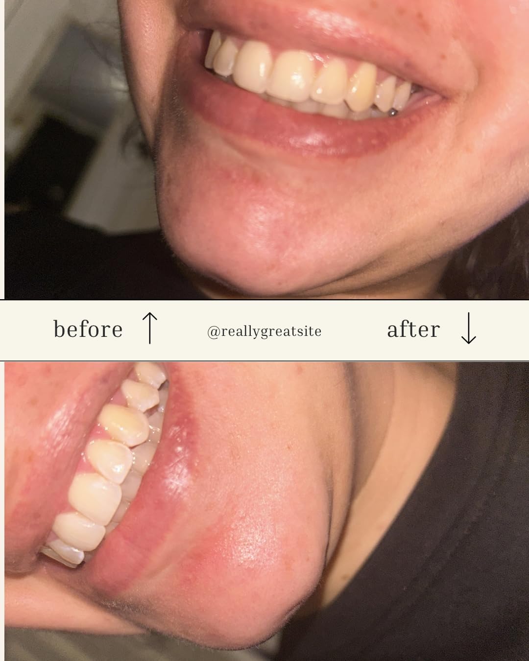 Auraglow Teeth Whitening Kit, LED Accelerator Light, 35% Carbamide Peroxide Teeth Whitening Gel, 20+ Whitening Treatments, Whitens up to 10 Shades in 7 Days customer photo 1