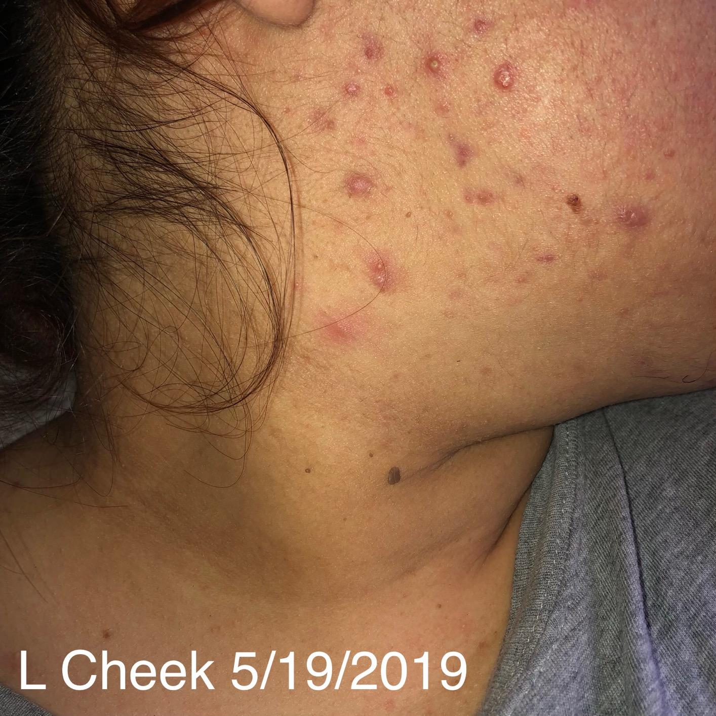 Eva Naturals Vitamin C Serum for Face - Anti Aging Dark Spot Remover & Corrector with Retinol, Hyaluronic Acid, Niacinamide & Salicylic Acid - Brightening, 1 fl oz customer photo 2