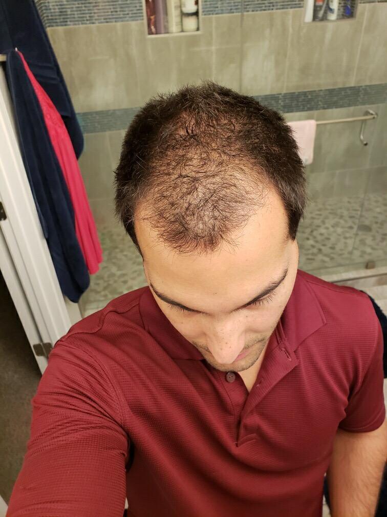 Elevate Hair Fibers to Instantly Thicken & Completely Conceal Thinning Balding Areas Loss in 30 Seconds for Men & Women (BLACK) 28g Size - 100% Natural & Undetectable Keratin Fibers customer photo 1