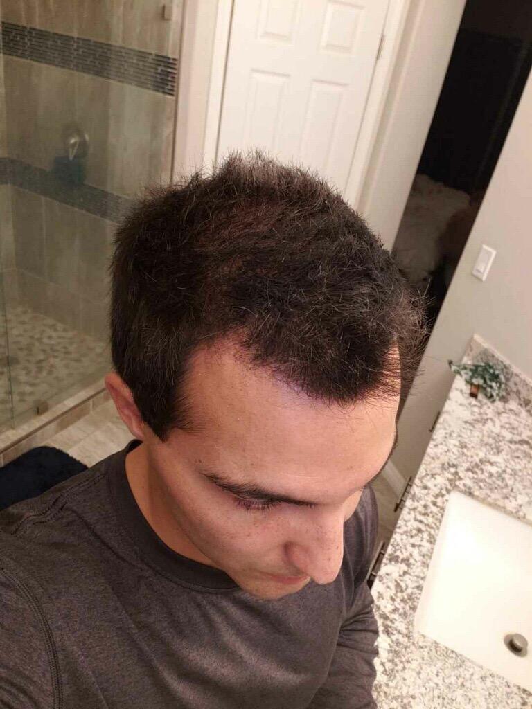 Elevate Hair Fibers to Instantly Thicken & Completely Conceal Thinning Balding Areas Loss in 30 Seconds for Men & Women (BLACK) 28g Size - 100% Natural & Undetectable Keratin Fibers customer photo 2