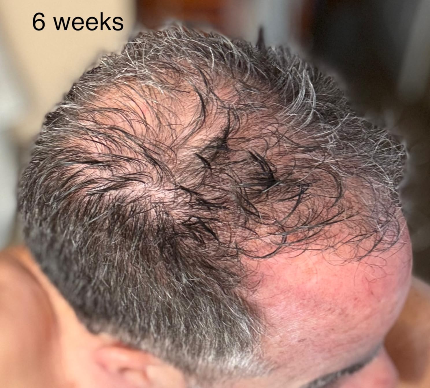 iRestore Professional Laser Red Light Therapy for Hair Growth System - FDA Cleared Hair Loss, Hair Thinning & Alopecia Treatment for Men & Women - 282 Lasers & LEDs customer photo 1