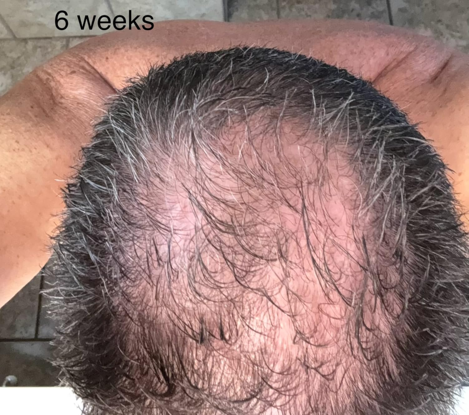 iRestore Professional Laser Red Light Therapy for Hair Growth System - FDA Cleared Hair Loss, Hair Thinning & Alopecia Treatment for Men & Women - 282 Lasers & LEDs customer photo 2