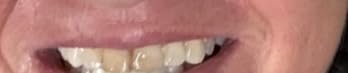 Crest 3D Whitestrips Professional Effects + LED Light - Teeth Whitening Kit, 1 Light + 20 Treatments, Each with 1 Upper/1Lower, 40 Strips - Crest 3DWhite Teeth Whitening Strips customer photo 1