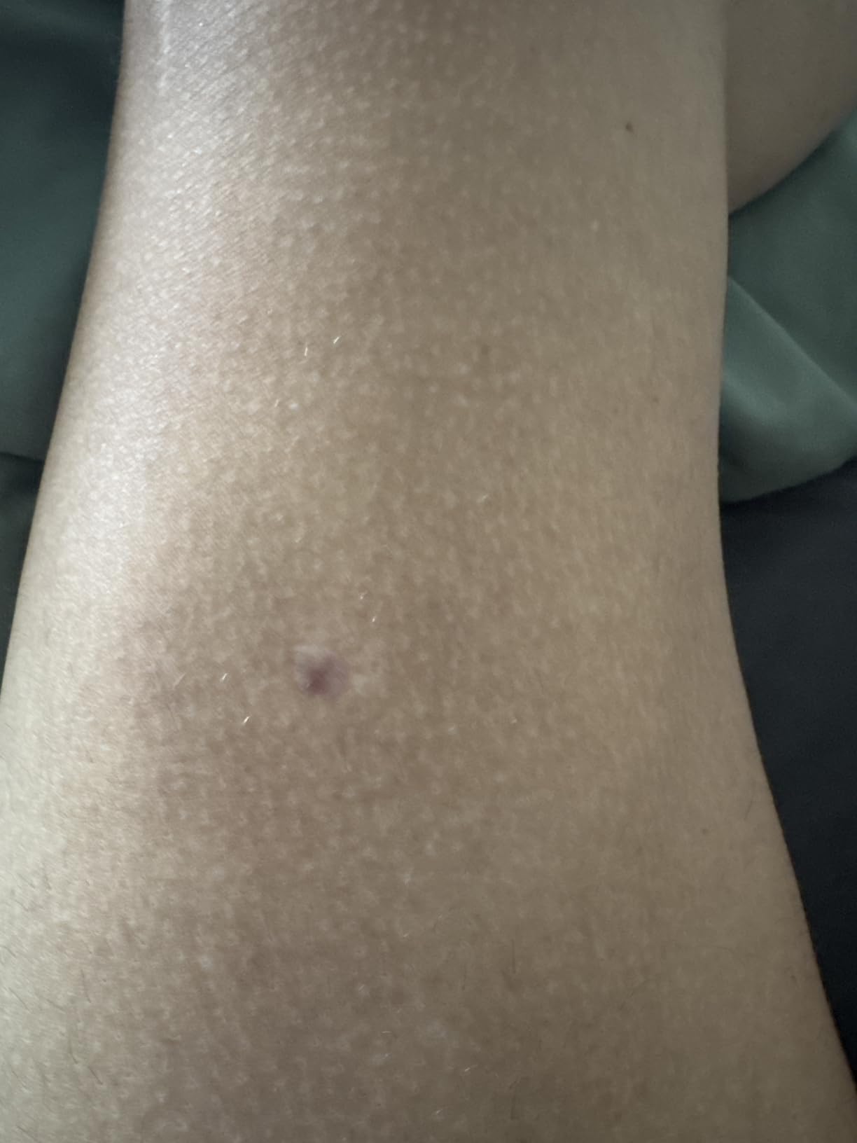 Ubroo Laser Hair Removal Hair Reduction in 2 Session(Gold) customer photo 1